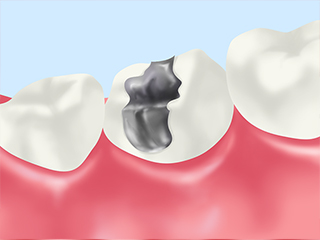 銀歯のリスクをご存知ですか？