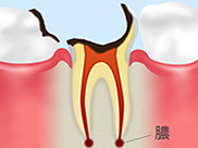 歯の根の虫歯