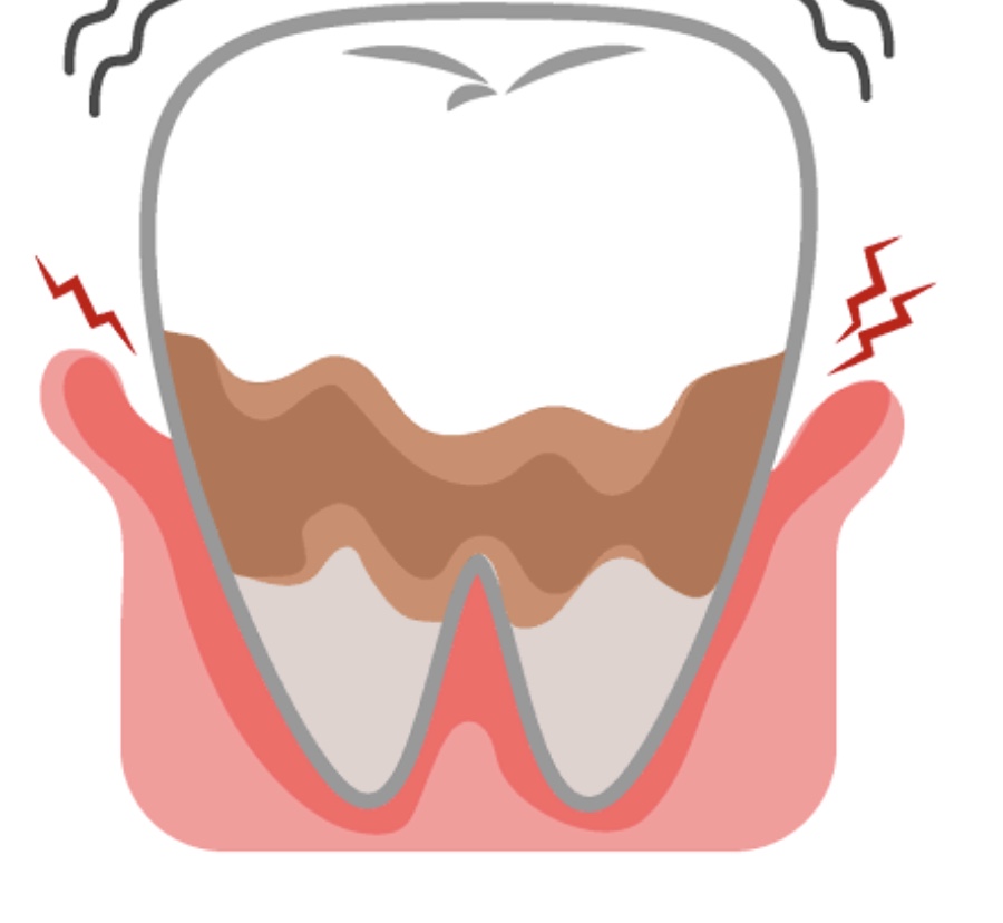 歯周病検査について